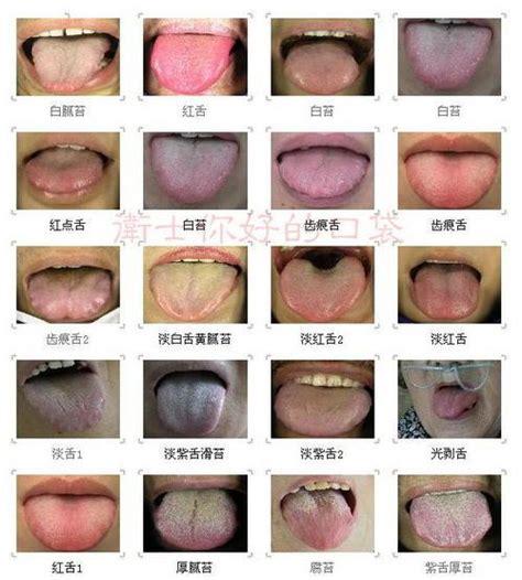 舌顏色|身體不好看「舌頭」就知道！顏色、外觀都是關鍵：「6種舌相」一